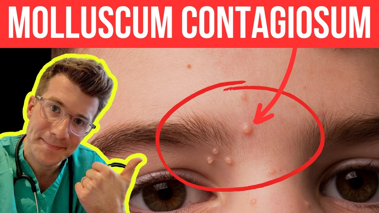Doctor explains Molloscum Contagiosum (viral skin infection) | Causes, symptoms and treatment