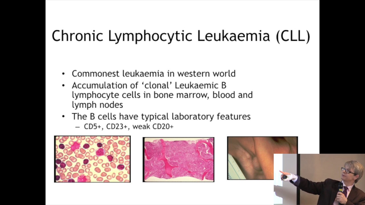 2019 Cambridge Dr Follows presentation about CLL at CLL Support conference