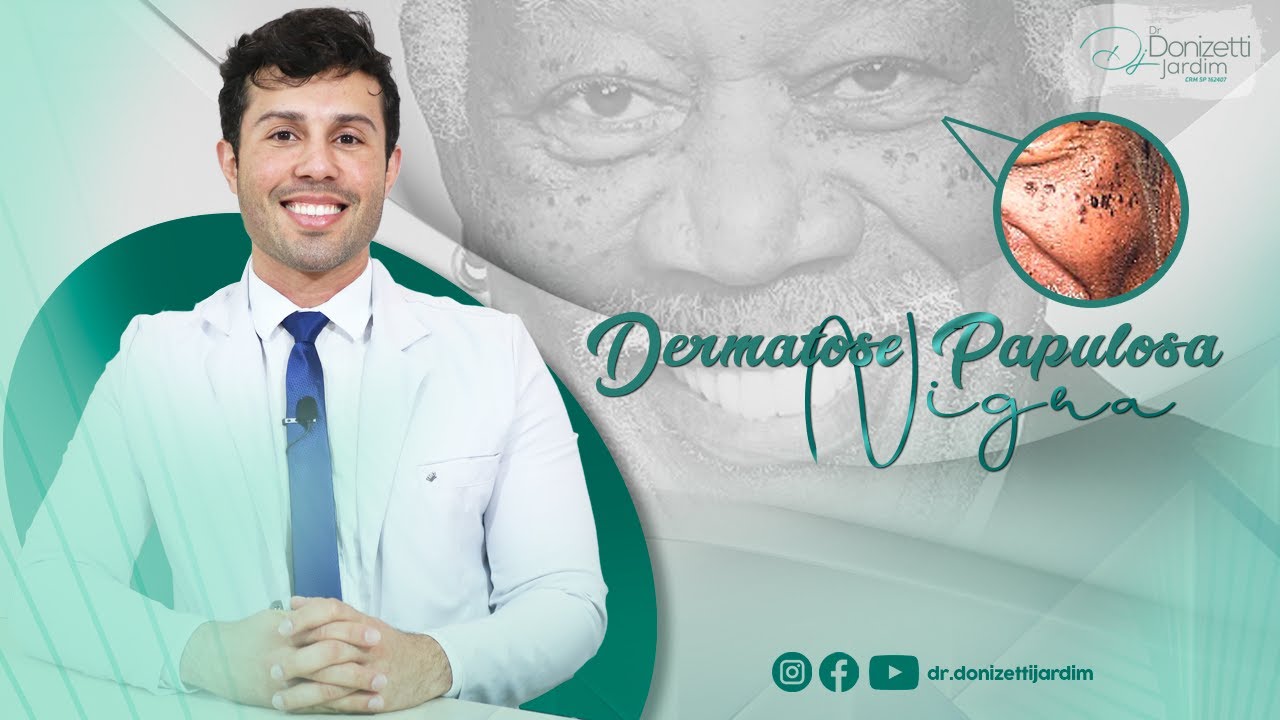 Como tratar a DERMATOSE PAPULOSA NIGRA - Dr. Donizetti Jardim