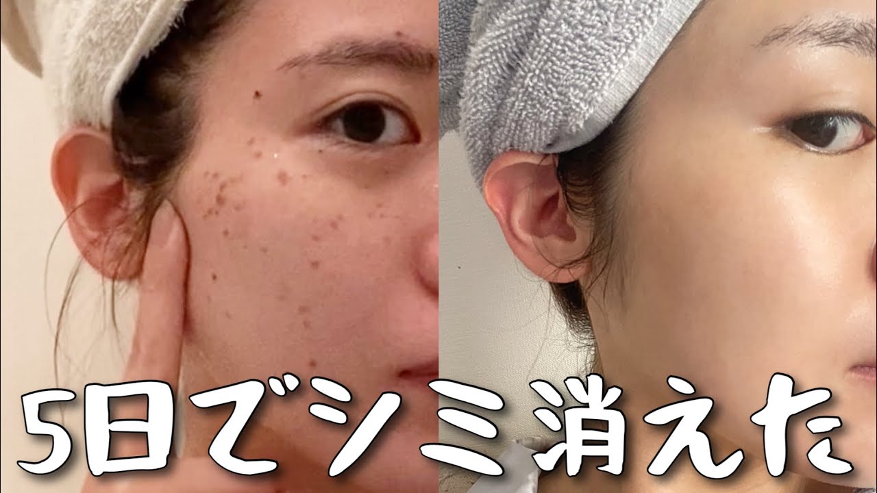 頑固なそばかすさようなら、、【シミ消し】
