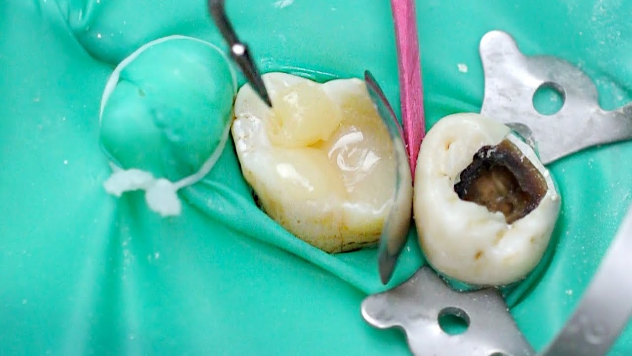 Odbudowa zęba z wypełnieniem - Samara Dentistry