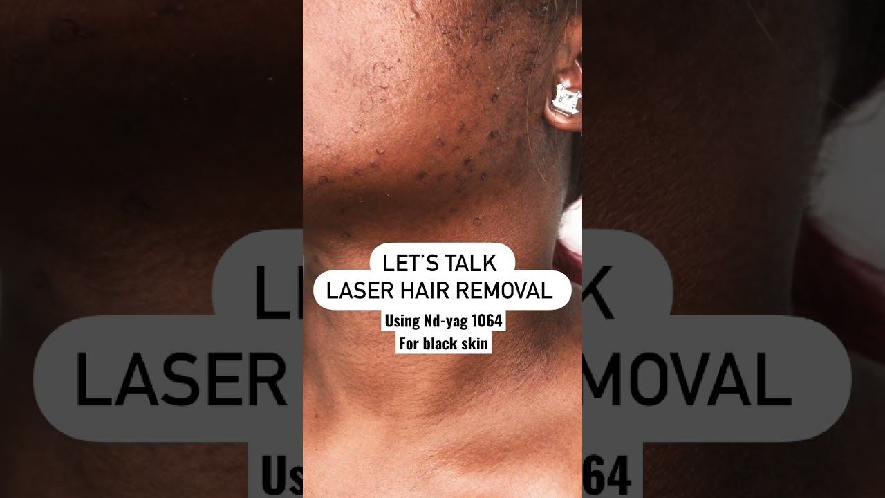Laser hair removal for black skin using ND-yag 1064nm |Fotona Laser