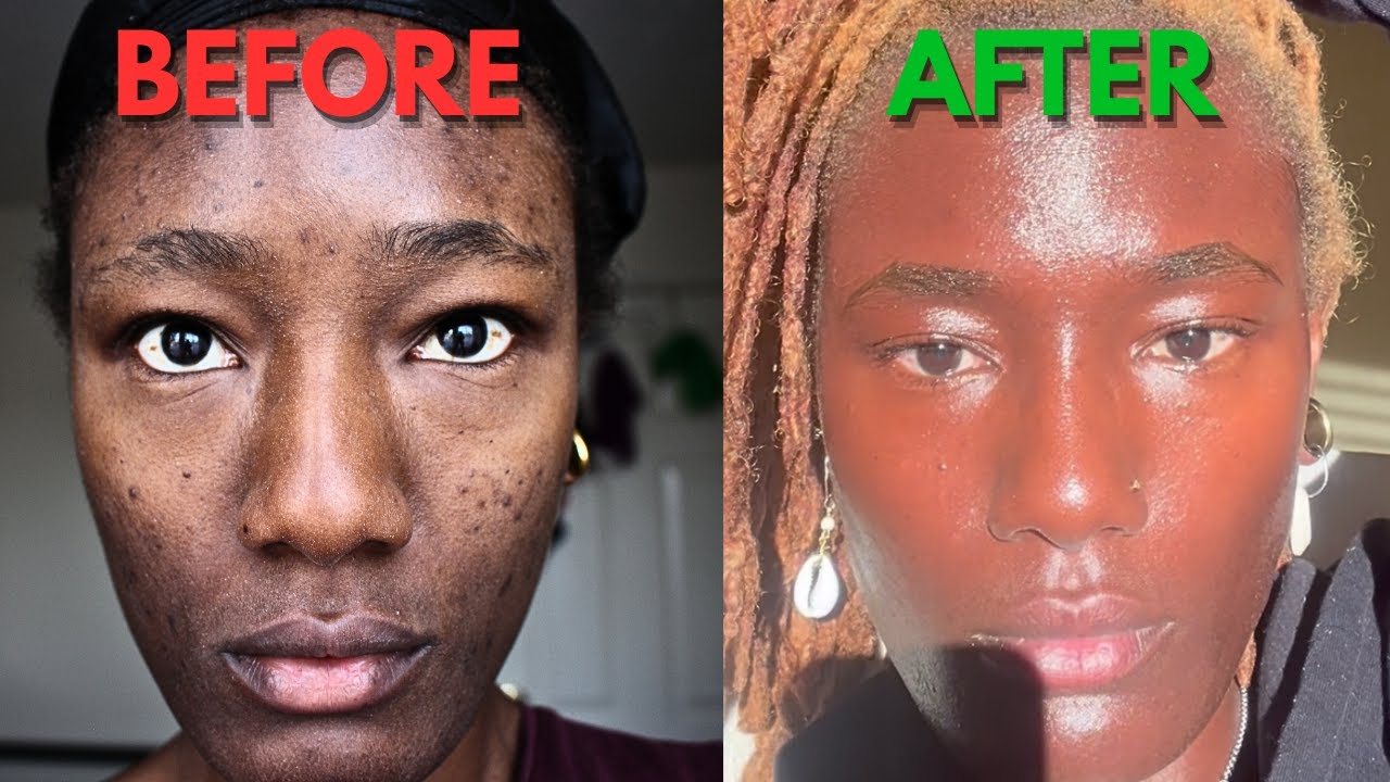 How to get CLEAR skin