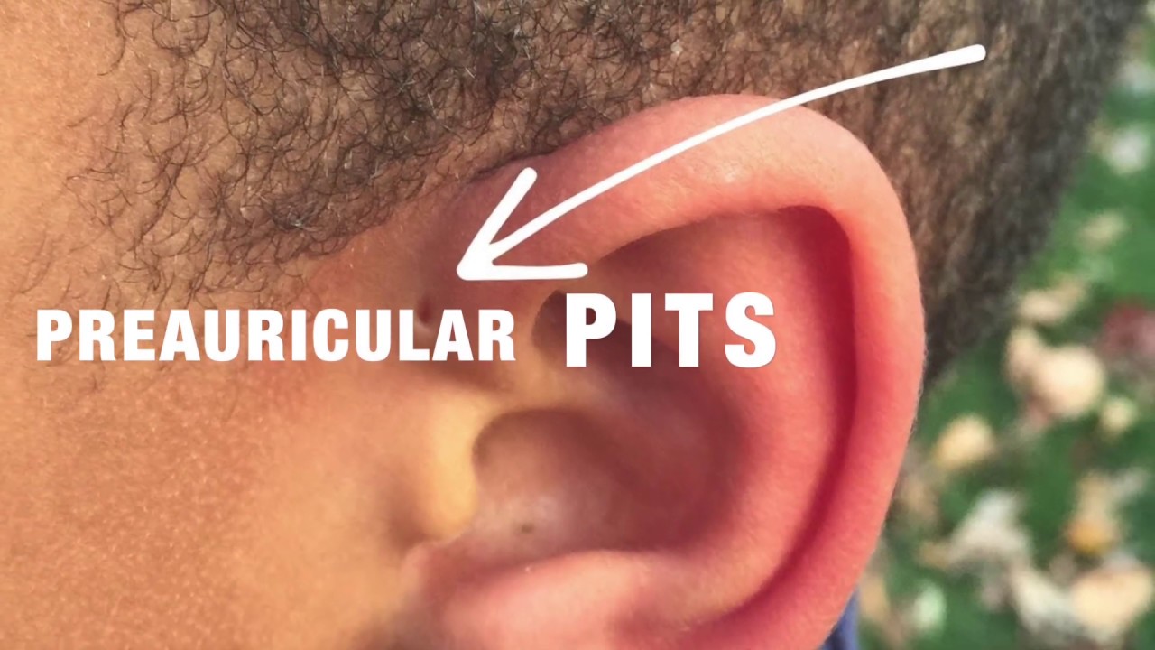 Preauricular Pits with Dr. David Mener