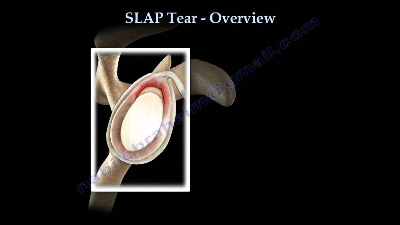 SLAP Tear Overview -  Everything You Need To Know - Dr. Nabil Ebraheim