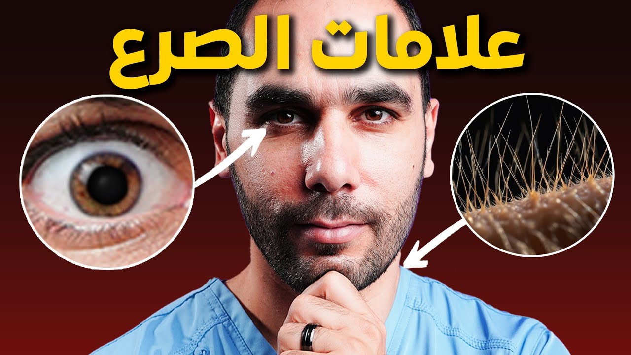 10 أعراض للصرع الغير معروفة