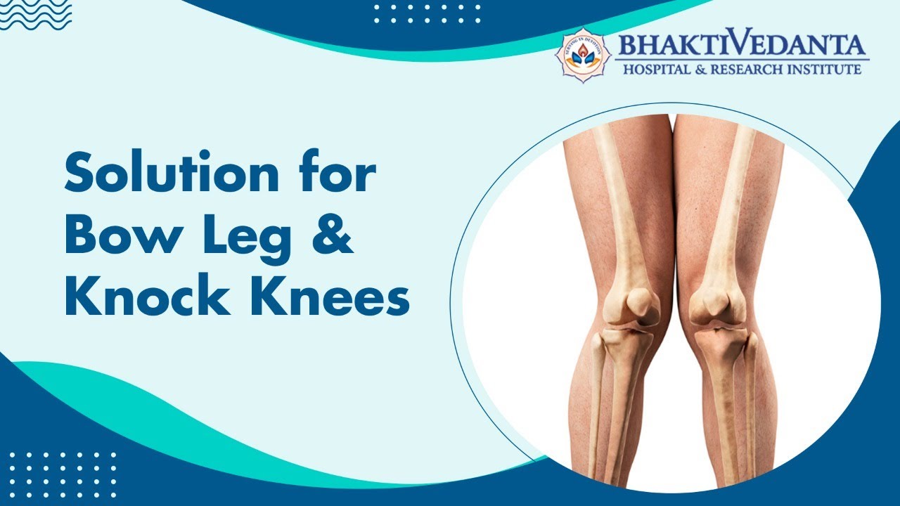 Bowlegs and Knock Knees in Children | Causes and Treatment | Bhaktivedanta Hospital