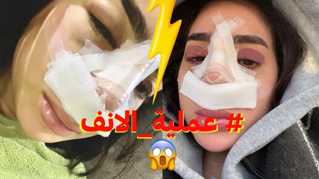 فلوق عملية انفي كاملة (مع النتيجه)🔥😰!