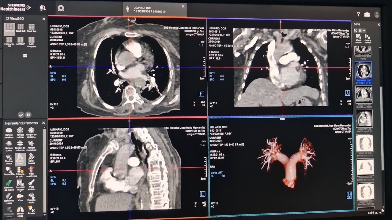 ANGIOTEP con bolus tracking SIEMENS SOMATON Go 64 cortes.