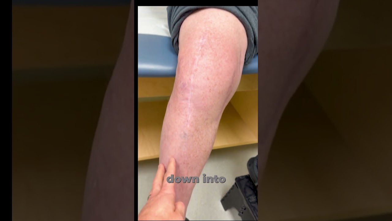 80% Knee Pain Gone in 2.5 Months &mdash; Nerve Surgery Changed Everything