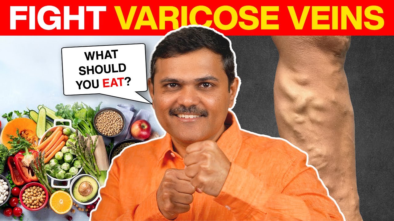 The Shocking TRUTH About Varicose Veins and DIET
