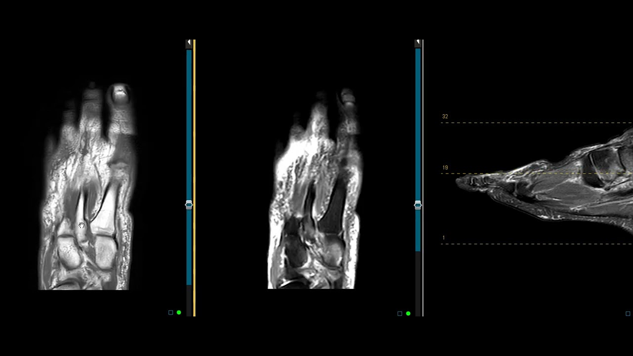 Lisfranc ligament tear and navicular fracture