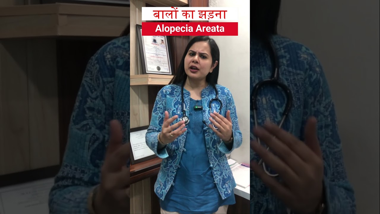 Homeopathy treatment of alopecia areata #drpratibhatanwar#homeopathydoctorindelhi