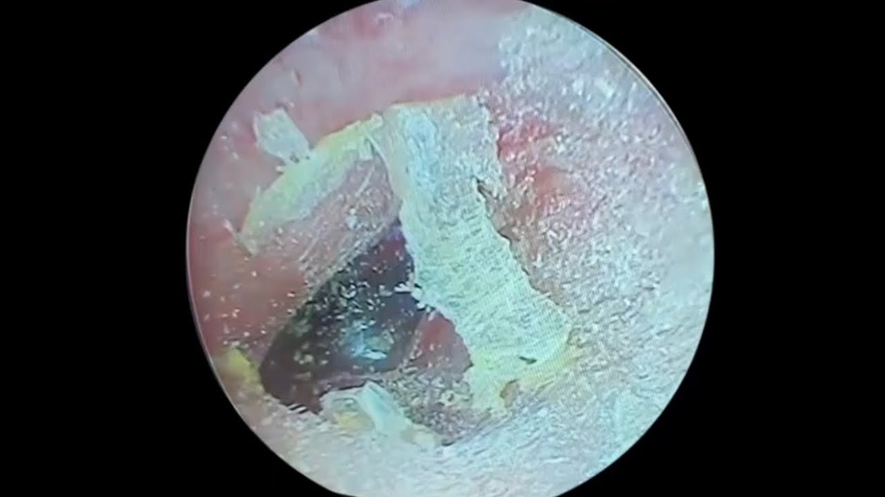 采耳哥-Cleaning the ear canal after applying medicated powder ｜729