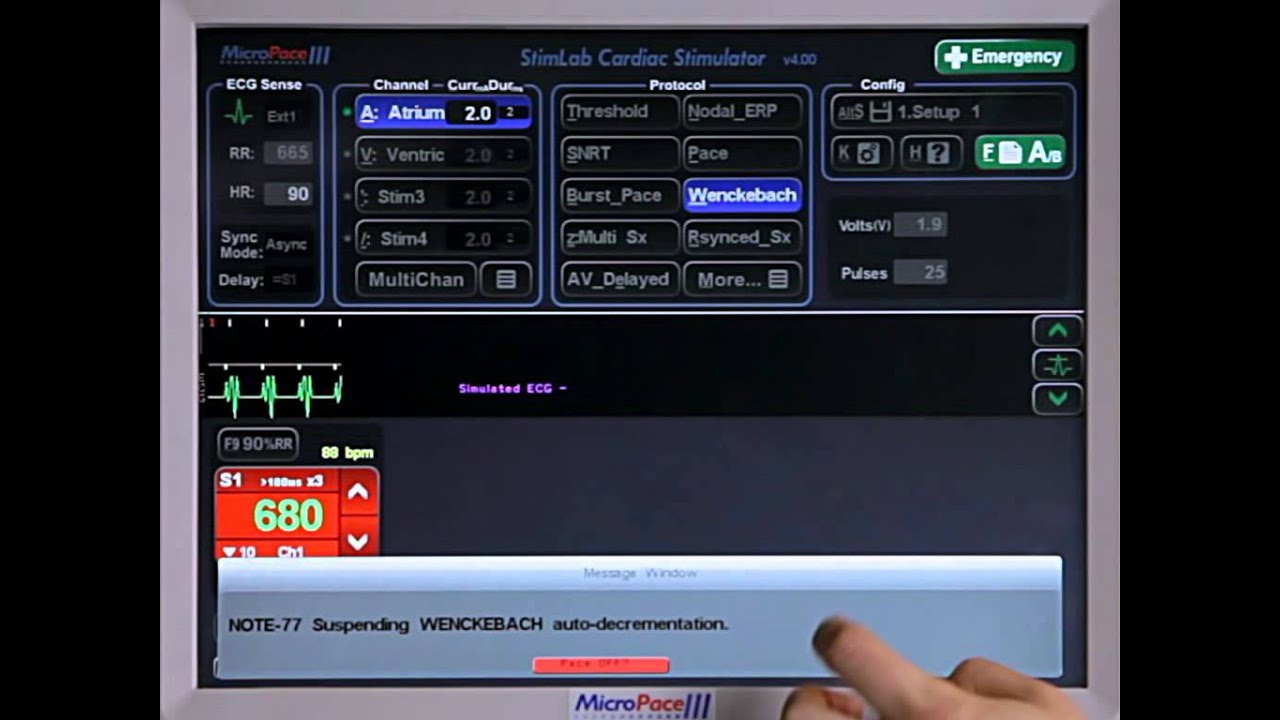 4D - Pacing Protocols - Wenckebach