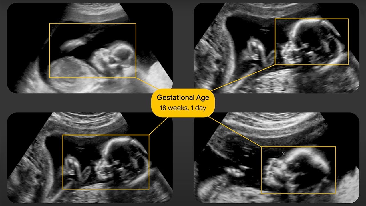 Expanding Ultrasound Access with AI | Google for Health