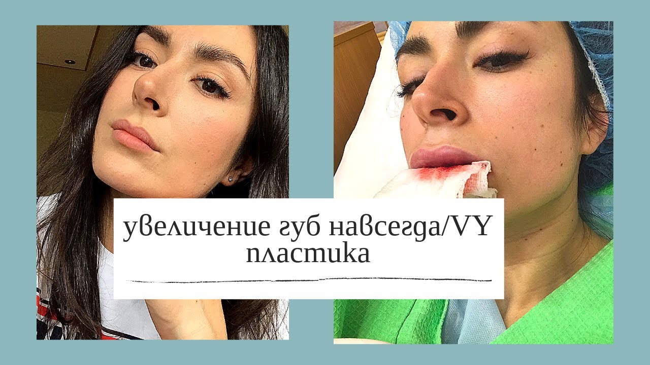 Увеличение губ навсегда или VY пластика