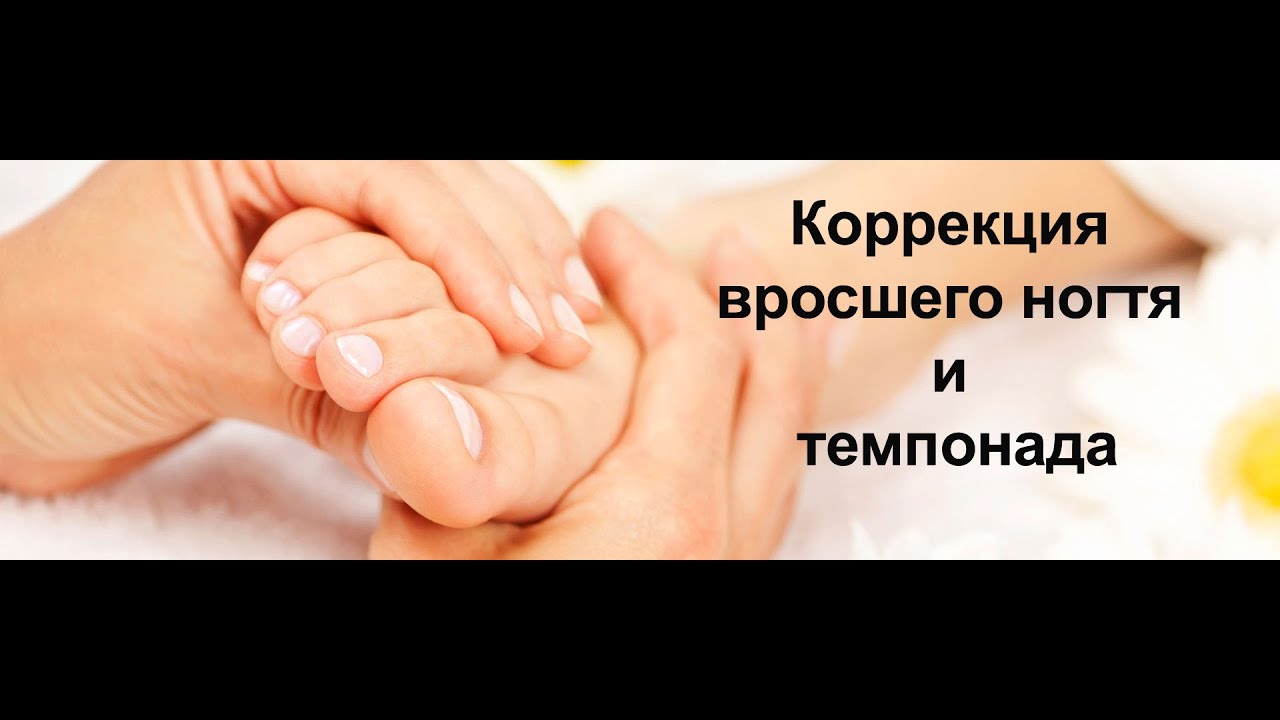 Коррекция вросшего ногтя и тампонада | Классический Педикюр | Correction of ingrown nail