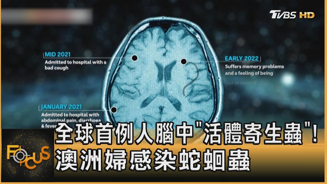 全球首例人腦中「活體寄生蟲」! 澳洲婦感染蛇蛔蟲｜方念華｜FOCUS全球新聞 20230830@TVBSNEWS01