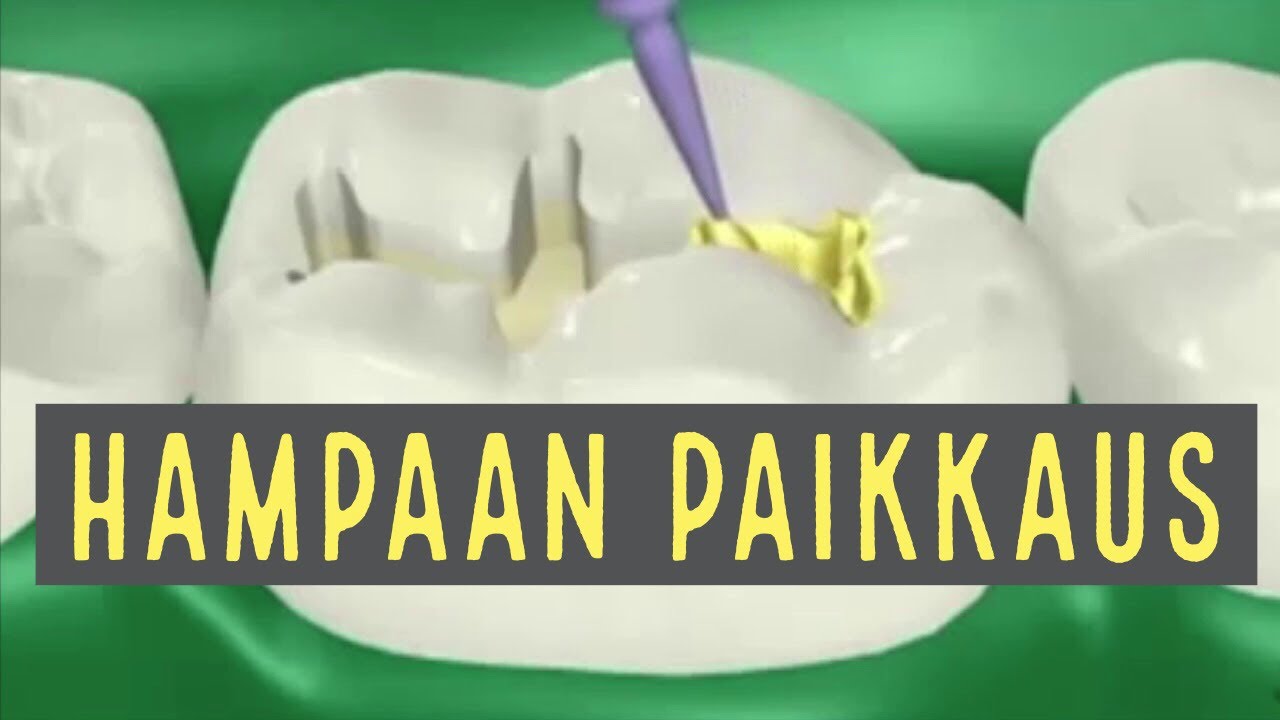 Hampaan Paikkaus ja sen vaiheet. Hammasl&auml;&auml;k&auml;ri kertoo