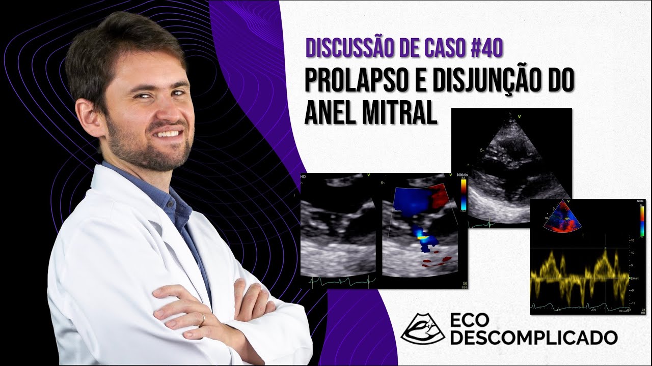 EcoDescomplicado - Discussão de caso AO VIVO #040 - Disjunção do Anel Mitral (MAD)