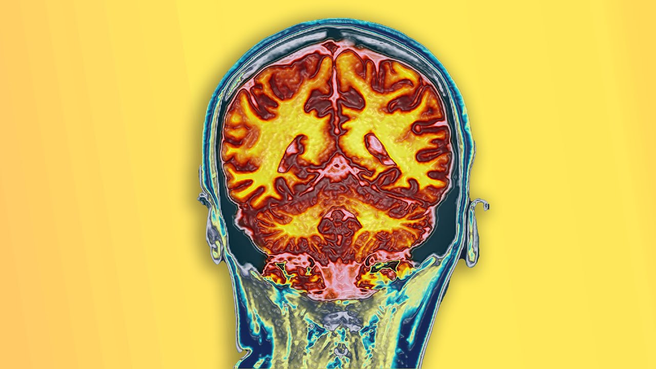 A Student Drank 2 Bottles Dextromethorphan. This Is What Happened To Her Brain.