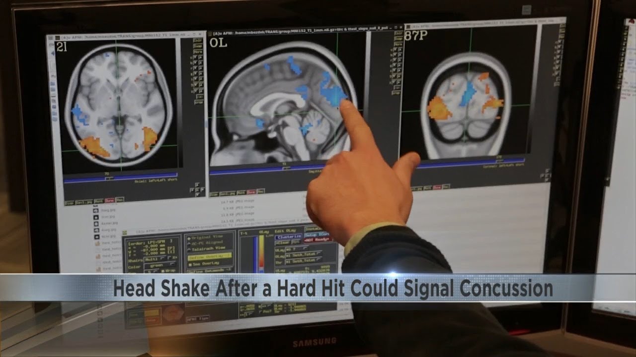A simple gesture could be a sign of a concussion