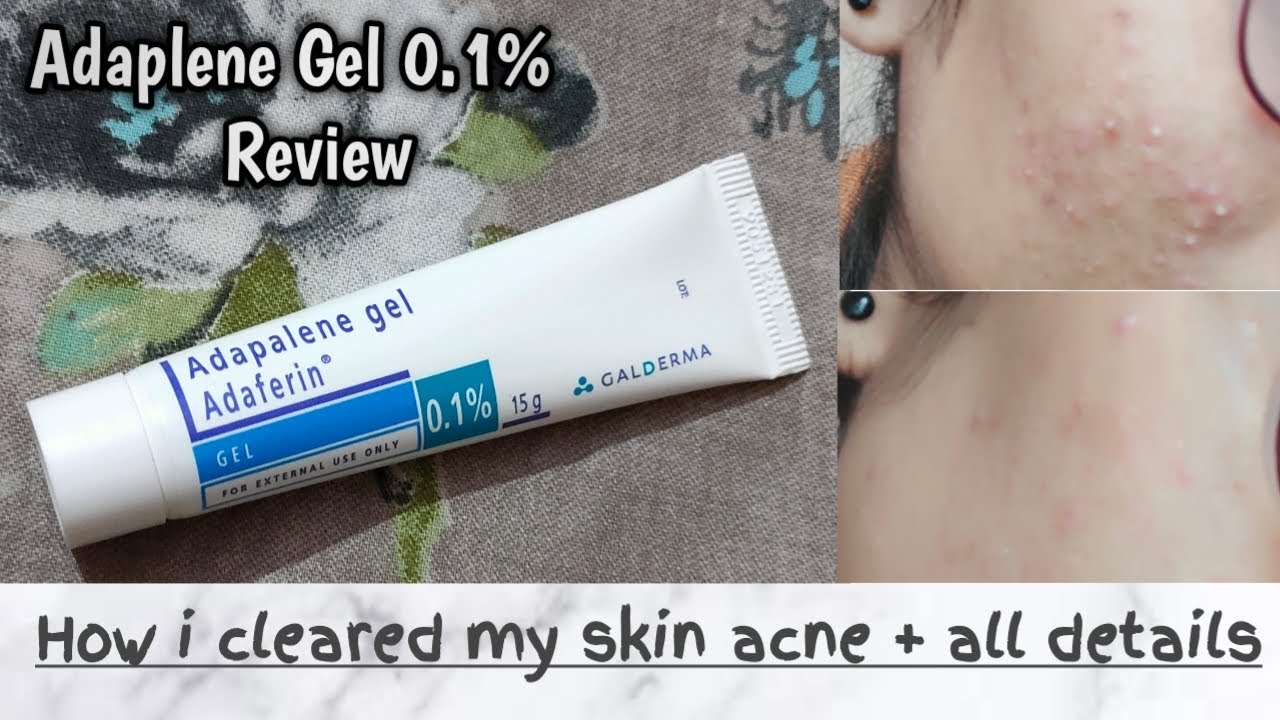 Adaplene 0.1% || Changed my skin 🤩 || adaferin gel
