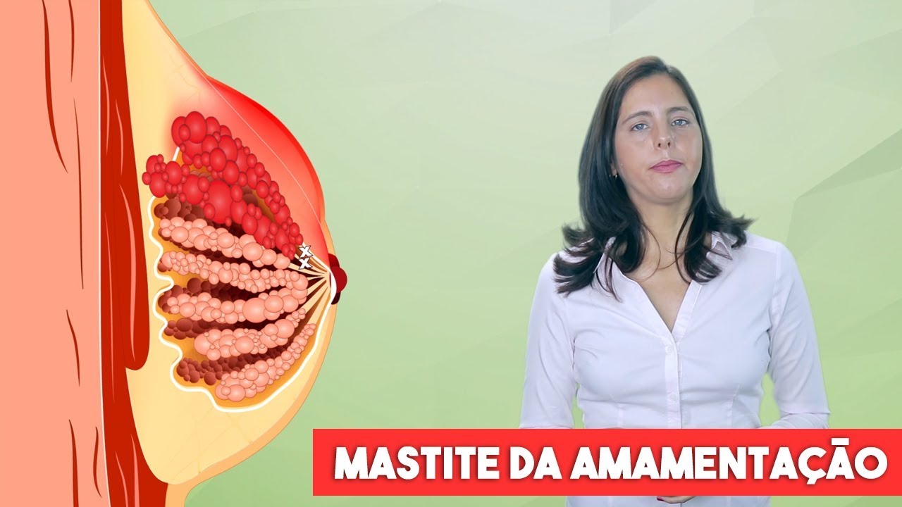 Mastite durante a amamentação (mastite lactacional)