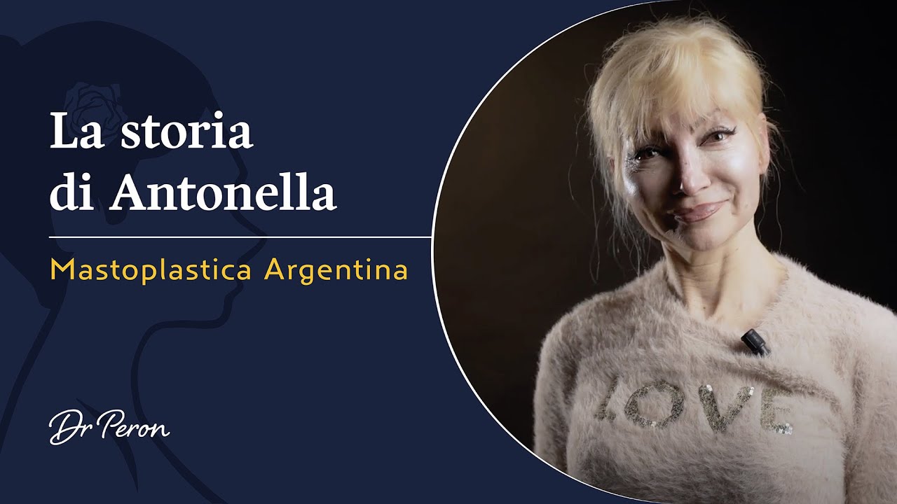 Testimonianza Mastoplastica Additiva: L'esperienza di Antonella
