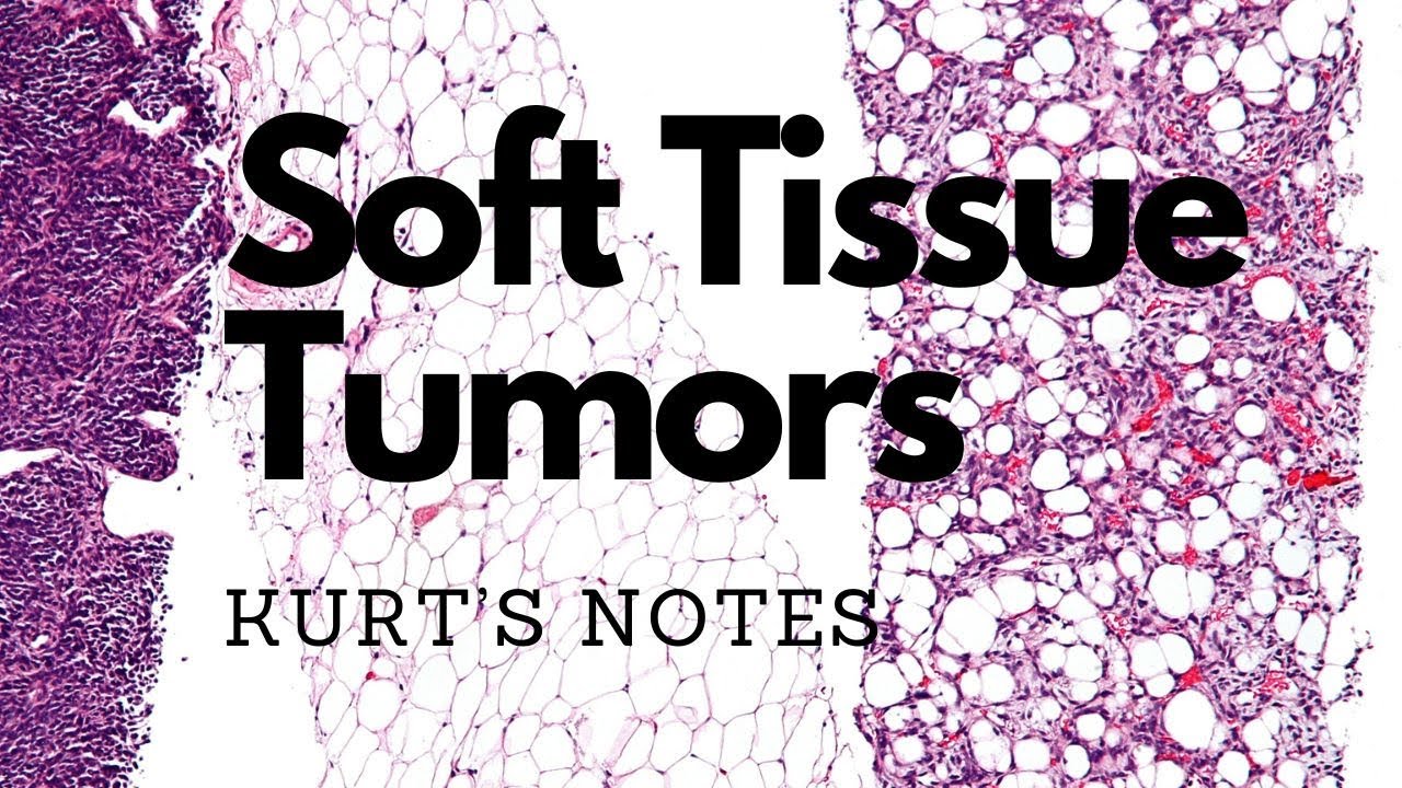 Soft Tissue Tumors: Kurt’s Notes #pathagonia