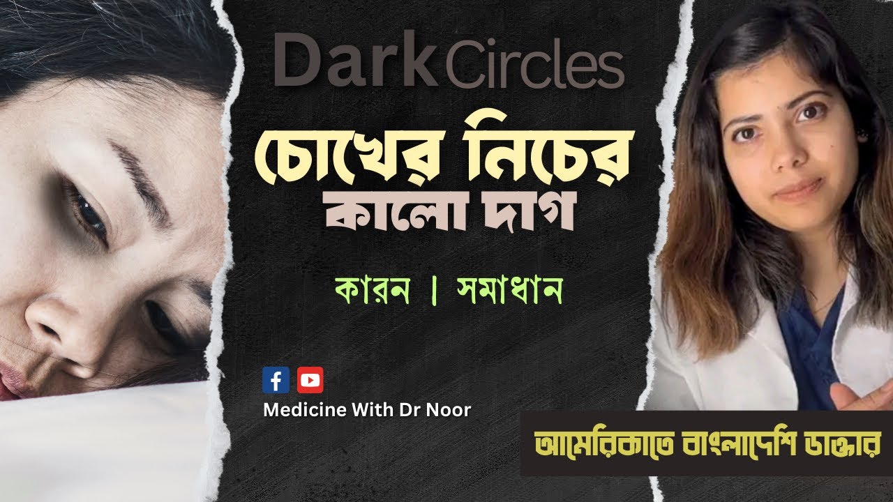 ডার্ক সার্কেল দূর করার উপায় । ডাক্তারের ভাষায় সমাধান। চোখের নিচের কালো দাগ বলিরেখা |  Dark Circles