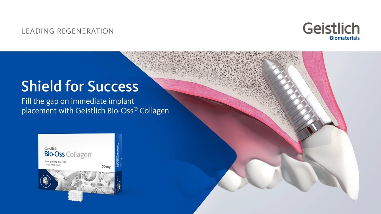 Fill the gap on immediate implant placement with Geistlich Bio-Oss&reg; Collagen