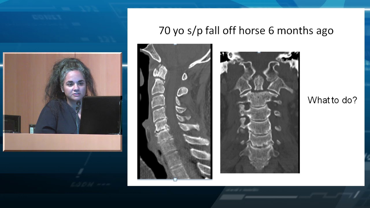 Management of Odontoid Fractures