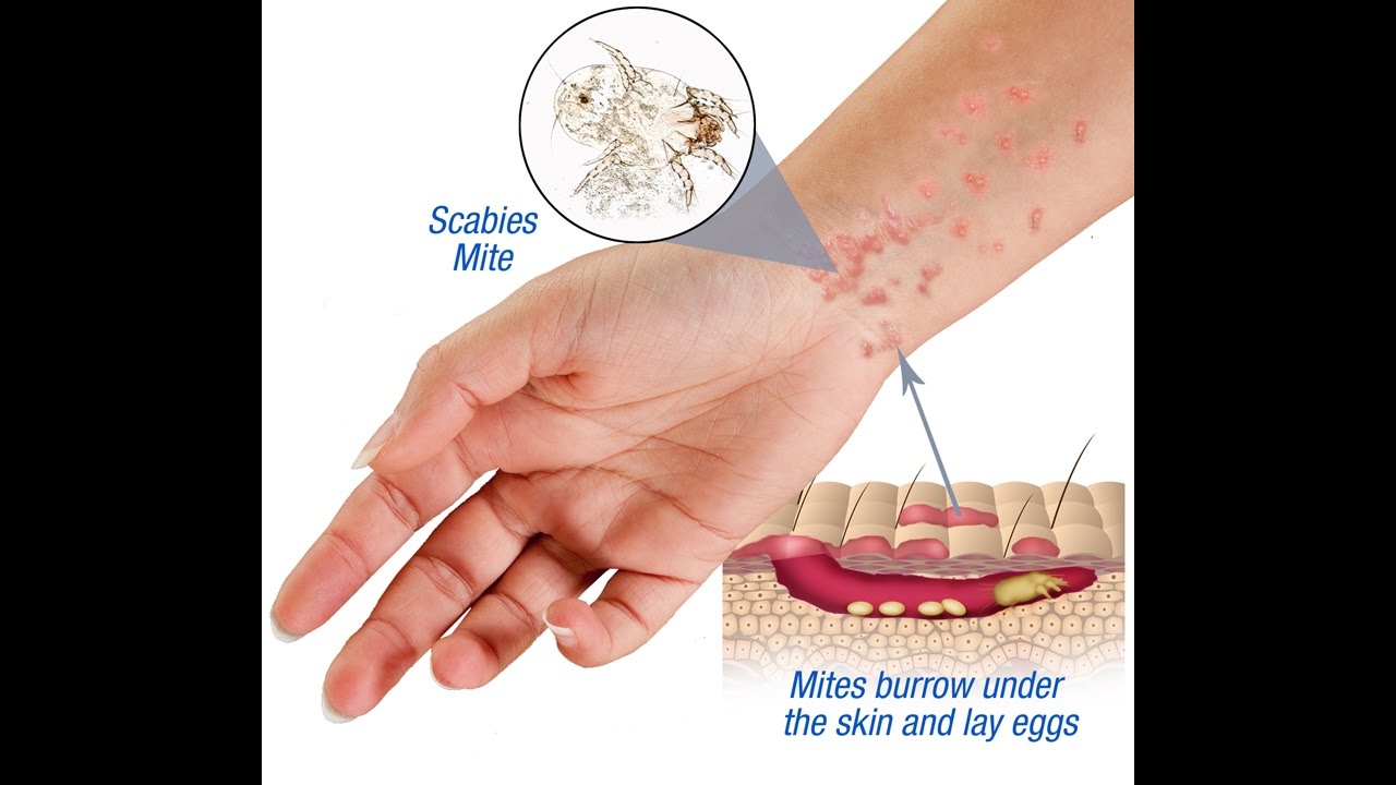 Scabies: Causes, Symptoms and Treatment