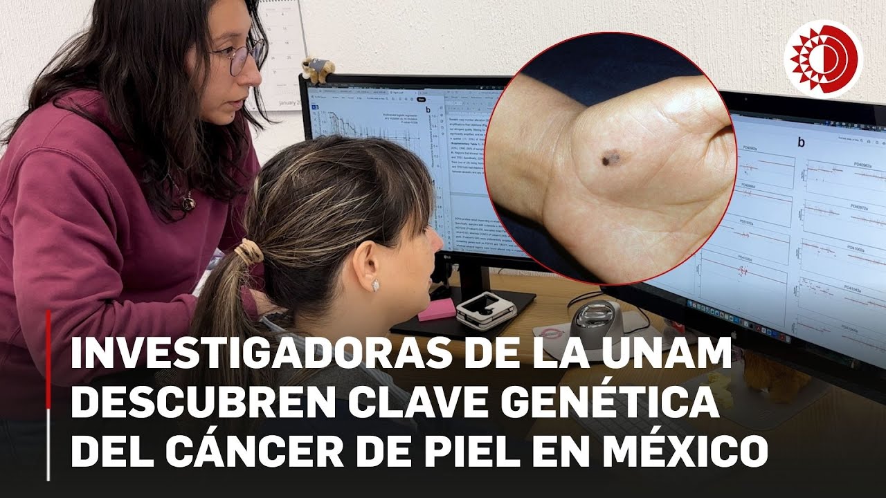 Hallazgo de la UNAM sienta bases para tratar el melanoma que más afecta a mexicanos