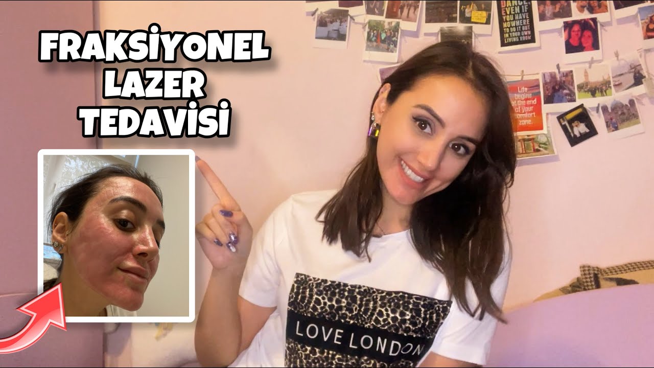 FRAKSİYONEL LAZER SÜRECİM / SİVİLCE VE AKNE İZİ TEDAVİSİ