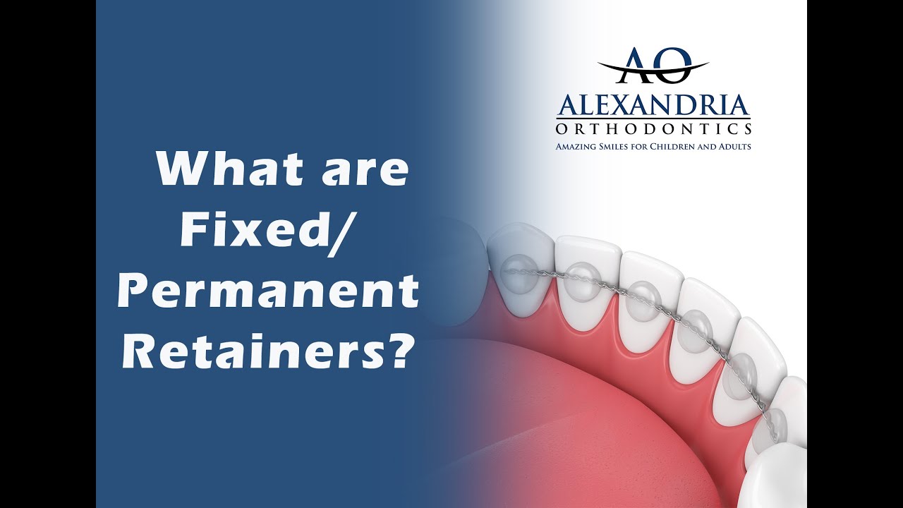 Alexandria Orthodontics: What is a fixed or permanent retainer?