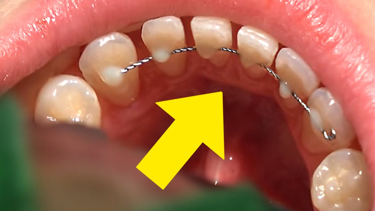 PERMANENT Retainers!! … Is it for YOU? | Orthodontist explains