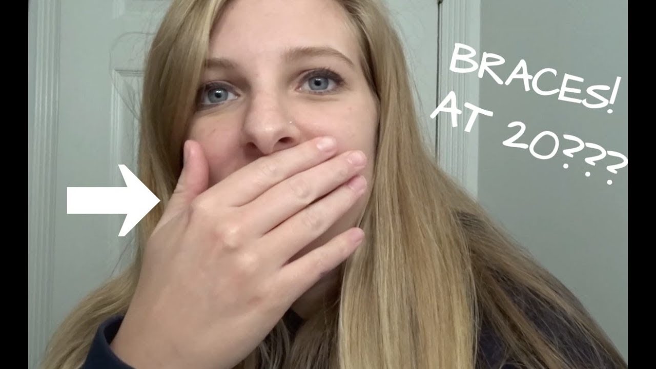 Getting Braces at Age 20!