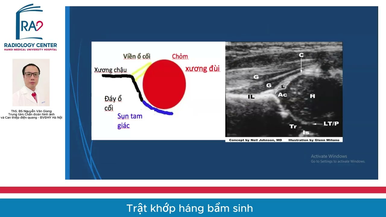 TRẬT KHỚP HÁNG BẨM SINH