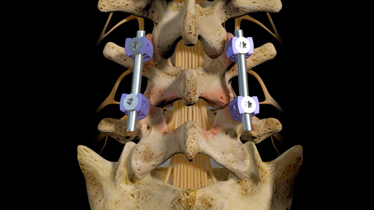 L4-5 Posterior Interbody Fusion