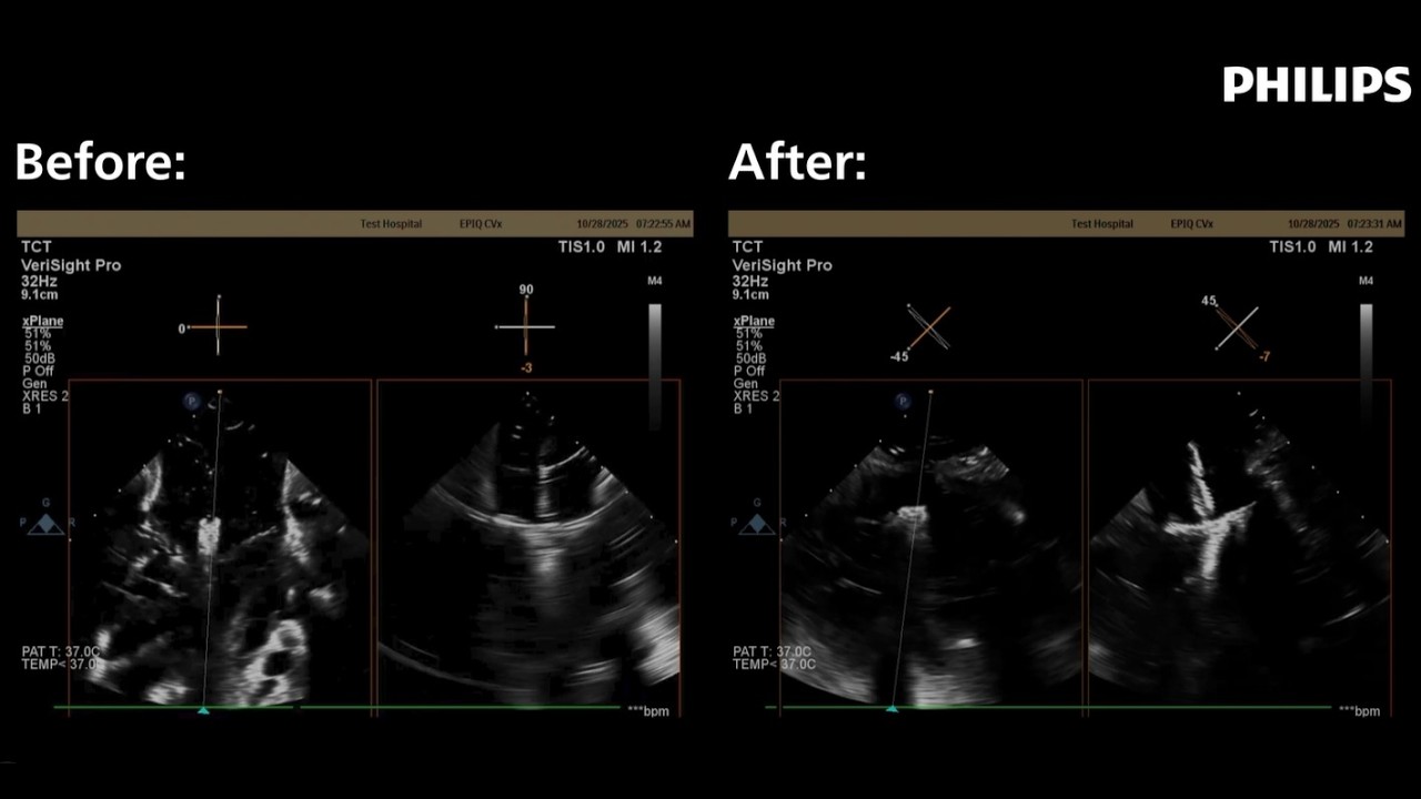 Step-by-step: Optimize grasping views during T-TEER with 3D ICE
