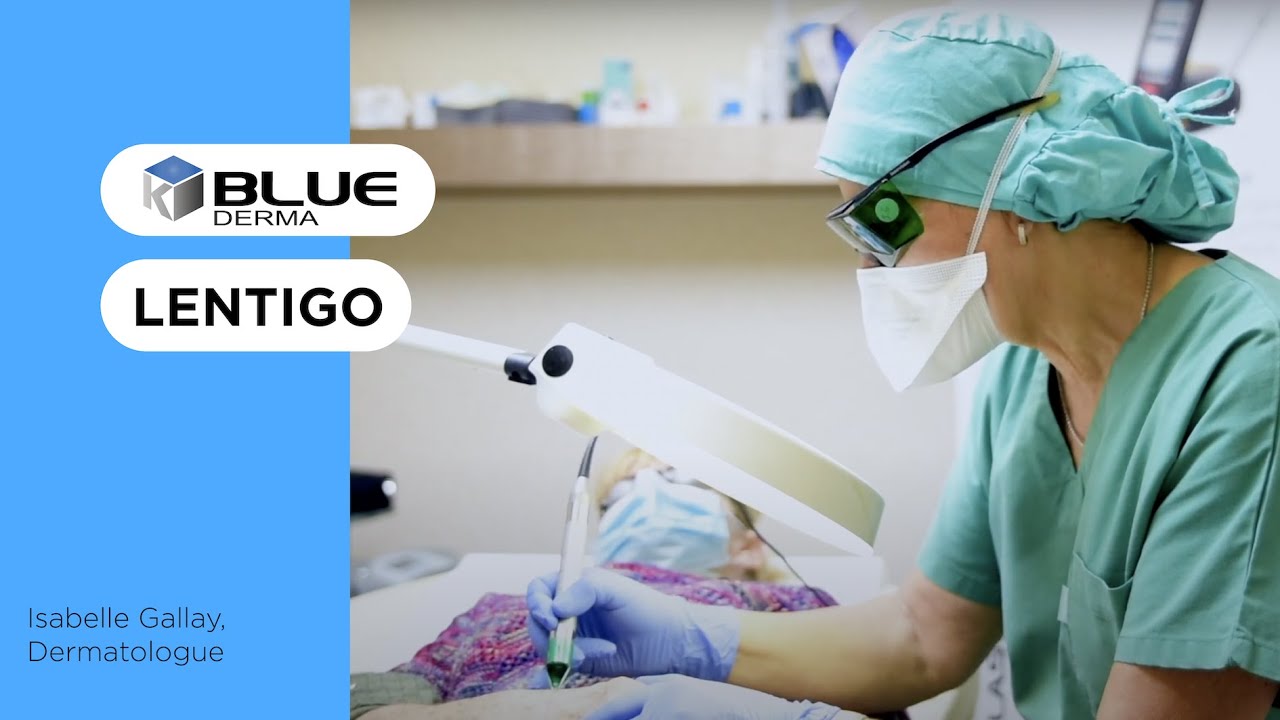 Lentigo (ou taches de vieillesse) traité au laser BLUE DERMA K-LASER