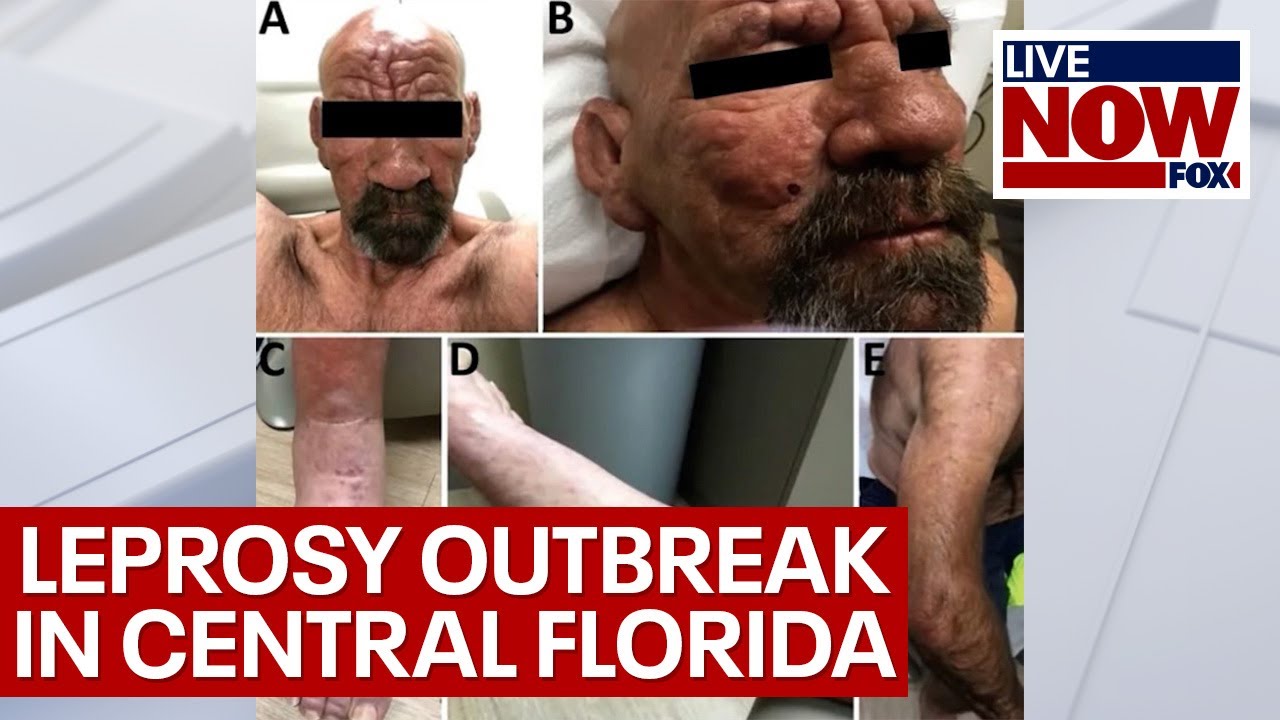 Leprosy in Florida: health officials consider it an 'endemic' | LiveNOW from FOX