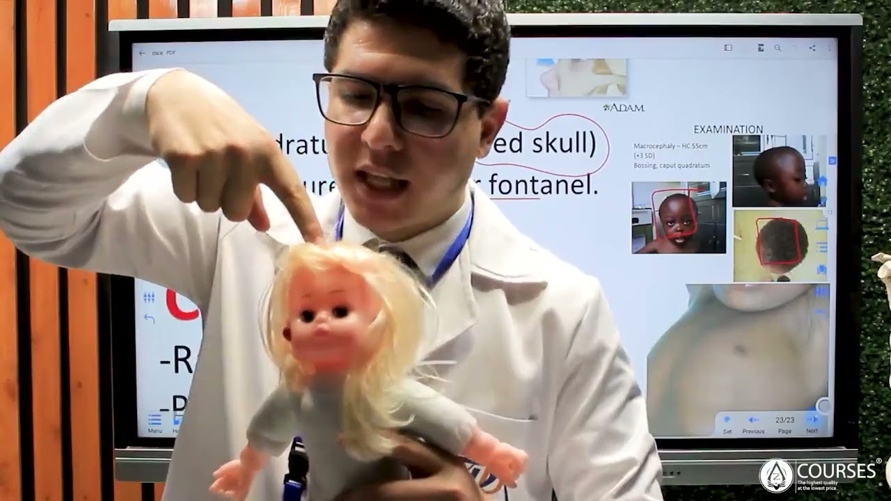 3 OSCE Rickets لين العظام