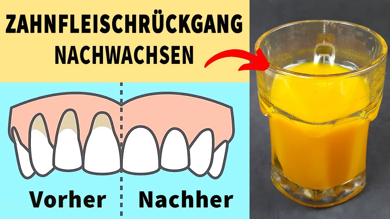 In 1 Minute, fixieren Sie Ihr Zahnfleischrückgang mit nur diesen 3 Zutaten