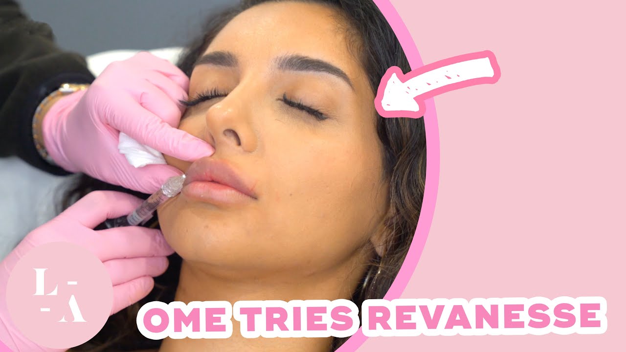 Ome Habiba | Revanesse Lip Filler Experience