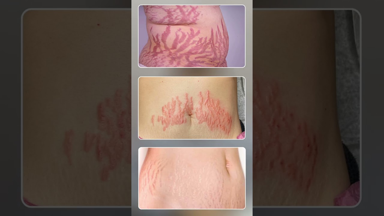 Stretch Marks Treatment | Dr Narendra Nikumbh #stretchmarksremoval