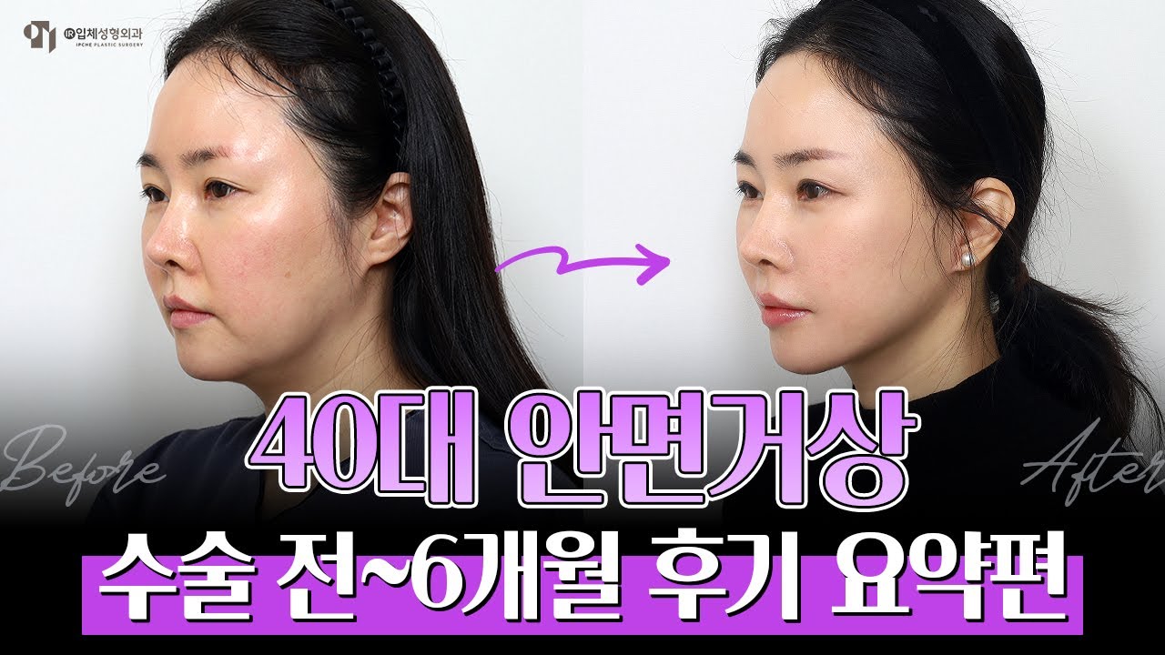 40대 안면거상 6개월 후기로 돌아왔어요! 수술 전~6개월 영상 한방에 보기❤️‍🔥